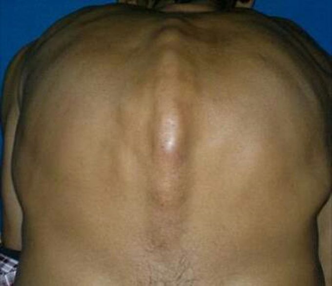 Kyphosis