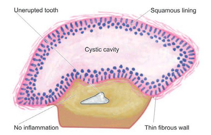 Dentigerous (Follicular) cyst.