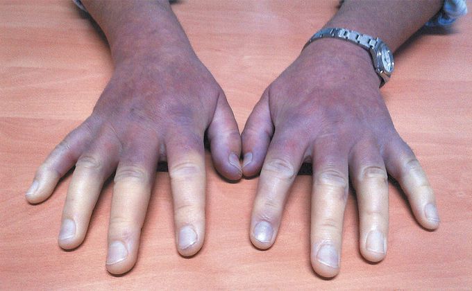 Cold Hands Associated with Scleroderma