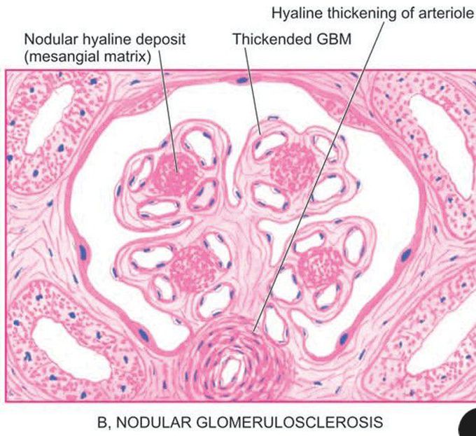 Diabetic glomerulosclerosis