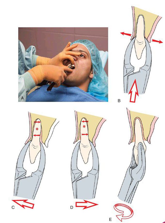 Maxillary incisors extraction