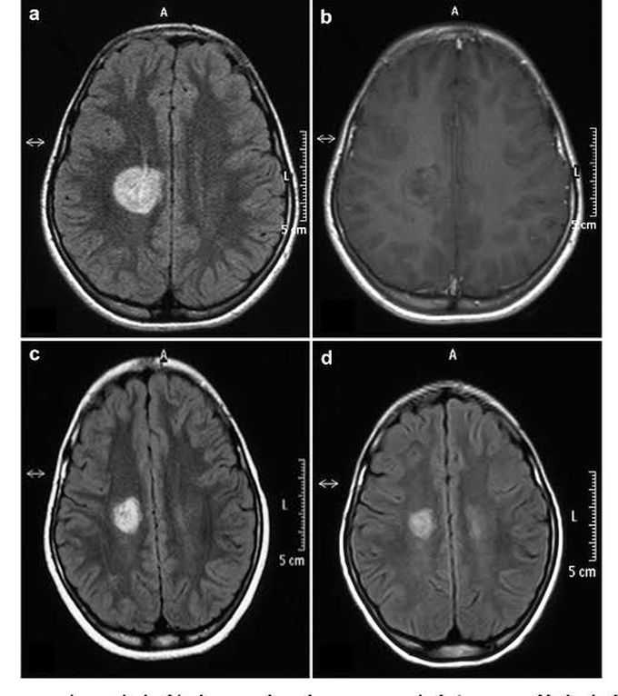 Schilder's sclerosis