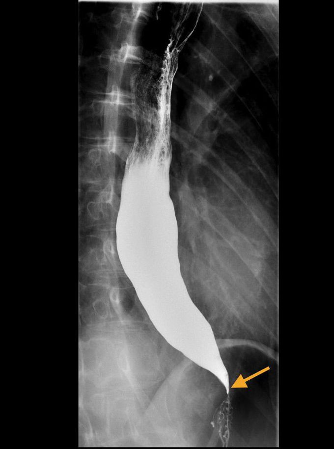 Achalasia
