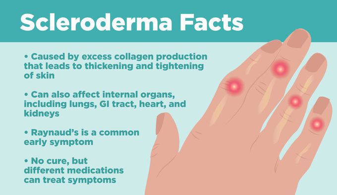 Causes of Scleroderma