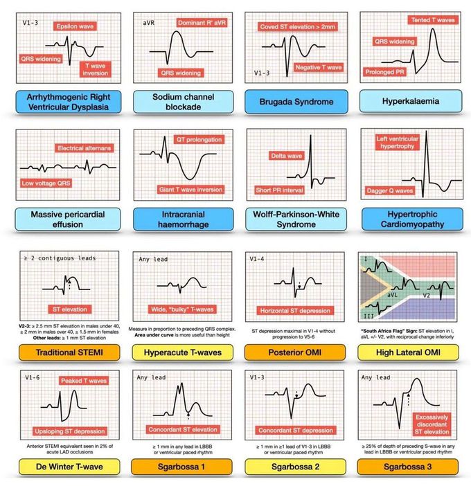 ECG Rhythm