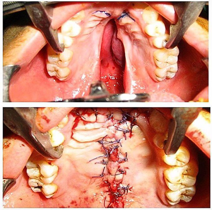 Cleft palate surgical repair!!!