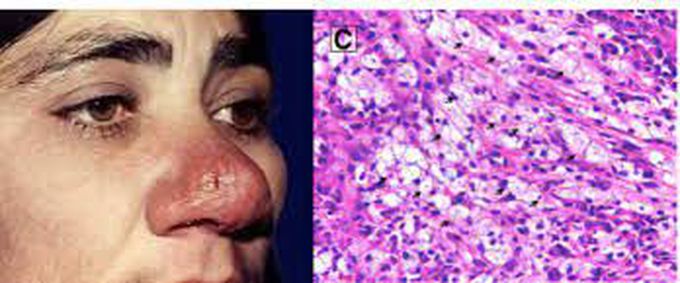 symptoms of rhinoscleroma