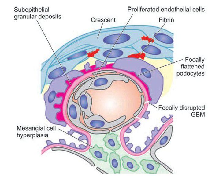 Rapidly progressive glomerulonephritis