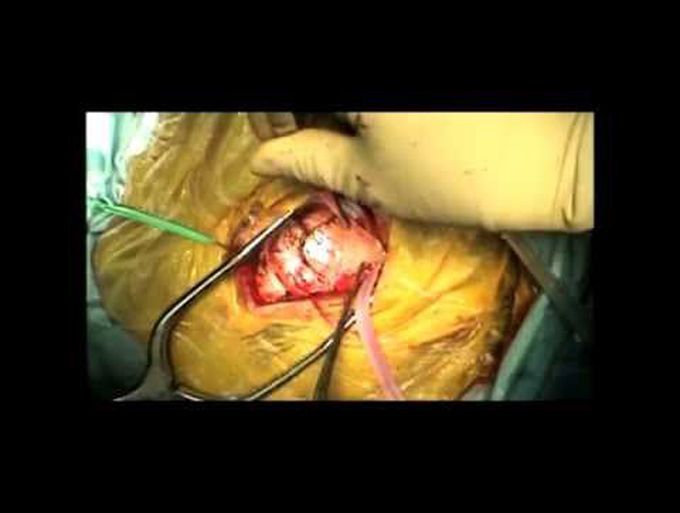 Retrosigmoid craniotomy for resection of acoustic neuroma with hearing preservation