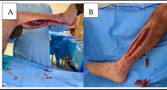 Treatment for Compartment syndrome