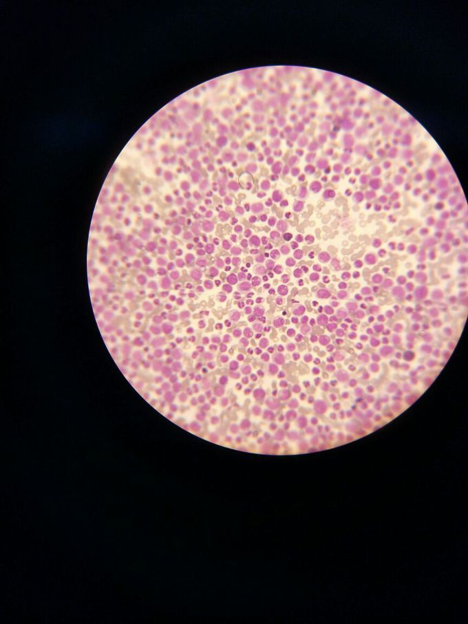 Peripheral smear