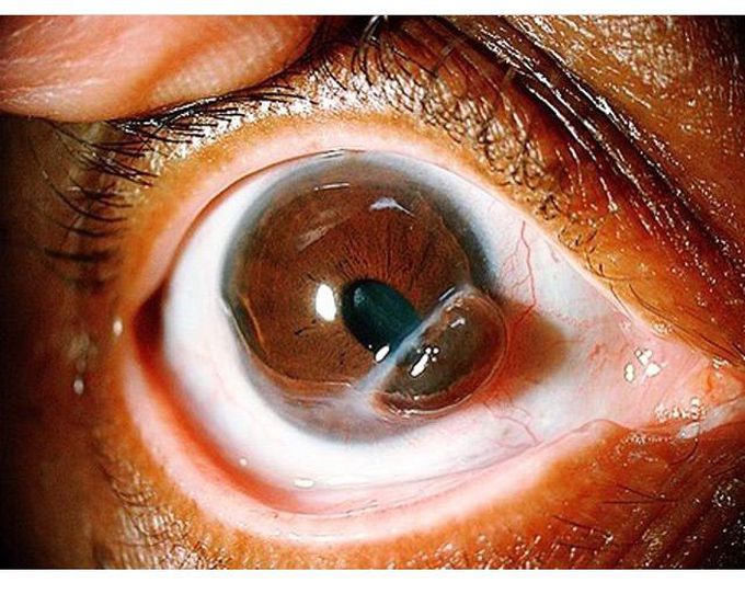Guess Syndrome