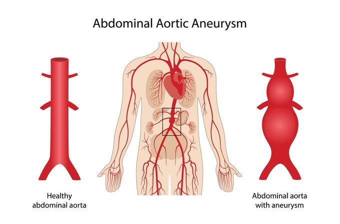 Causes of abdominal aortic aneurysm