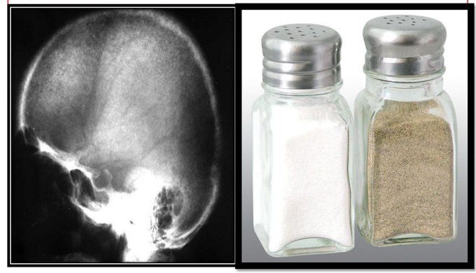 Learn #salt_pepper_skull in #hyperparathyroidism.