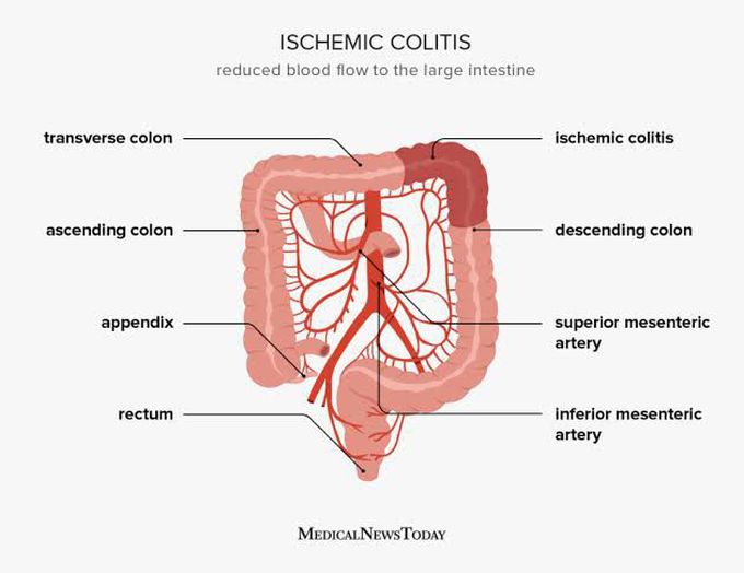 Ischemic Colitis