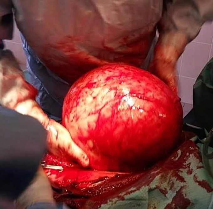 Sugical Removal of Cyst!