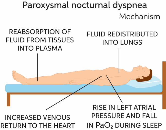 Symptoms of Paroxysmal nocturnal dyspnea