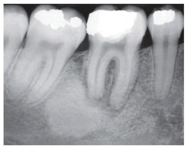 Sclerosing osteitis,