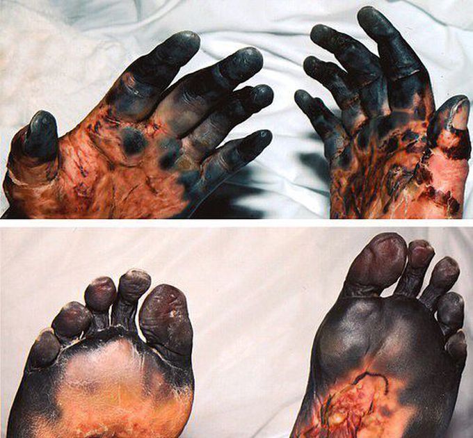 Severe systemic peripheral gangrene of all fingers and toes induced by polyarteritis nodosa!! 