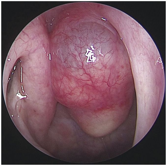 Tornwaldt’s Cyst