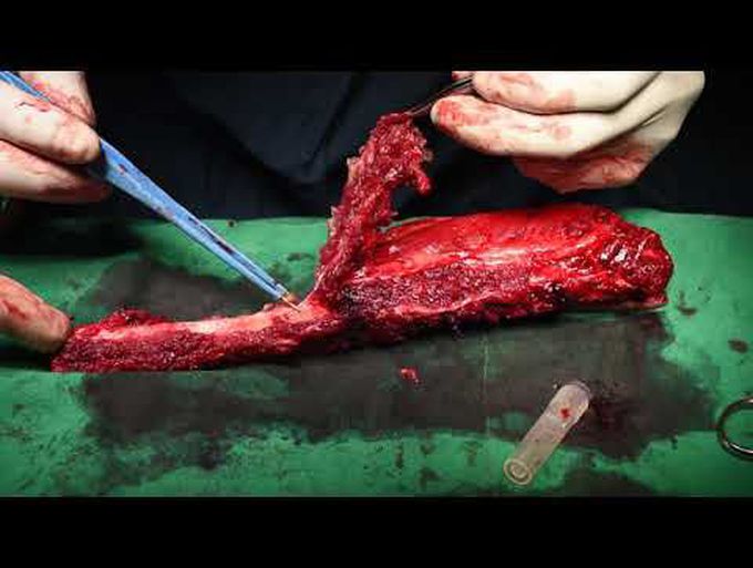 Fibula ostetomy part 2