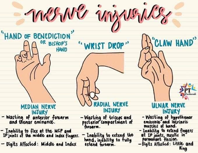 Hand deformities of nerve injury - MEDizzy