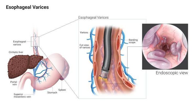 Esophageal Varices