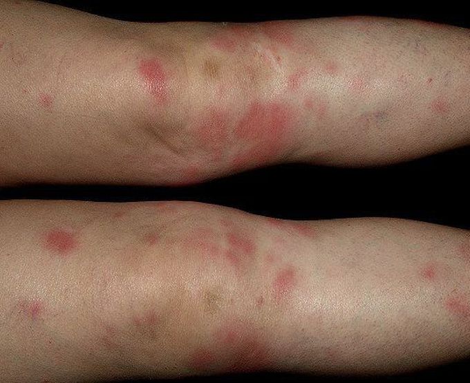 Erythema nodosum