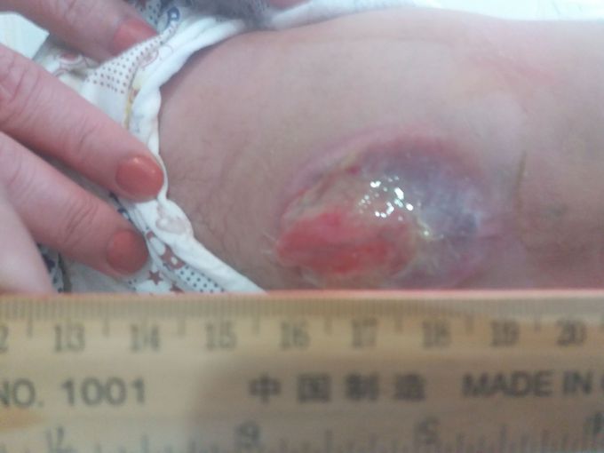 More alkohol in pregnancy
