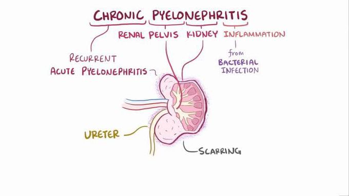 Chronic pyelonephritis