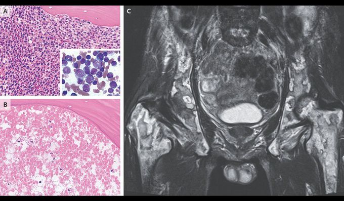 Bone Marrow Necrosis in Acute Monoblastic Leukemia