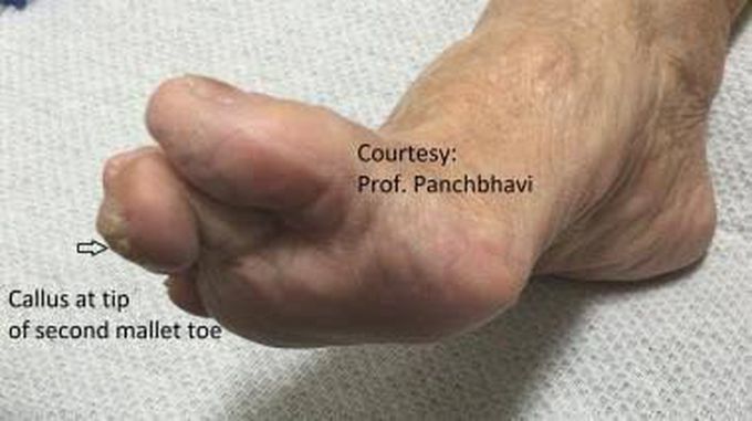 Causes of mallet toe