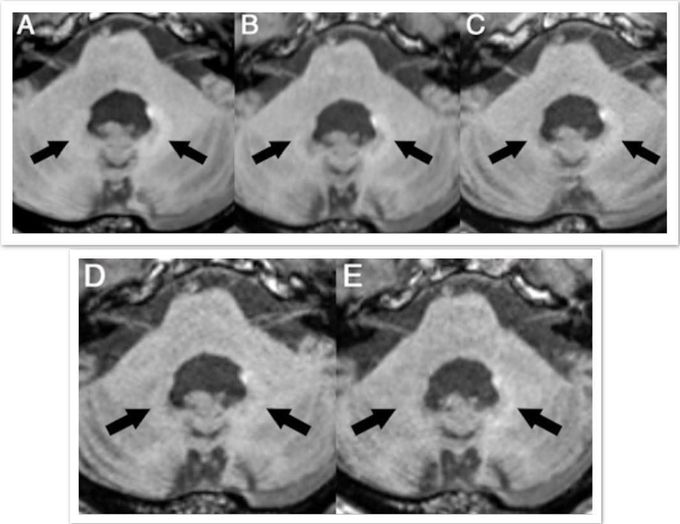 Post-MRI signals disappear with macrocyclic gadolinium