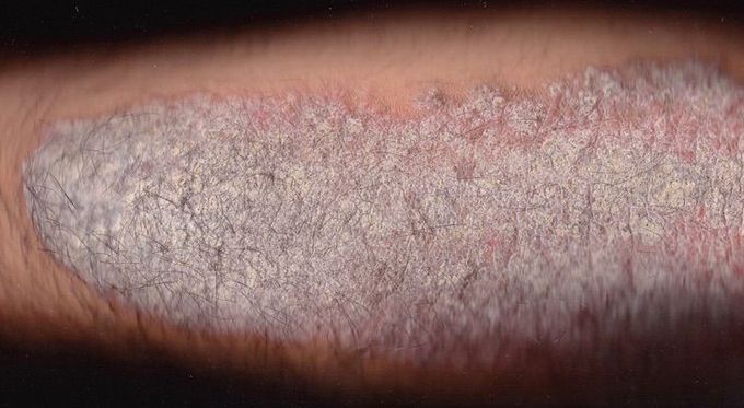 Skin disease