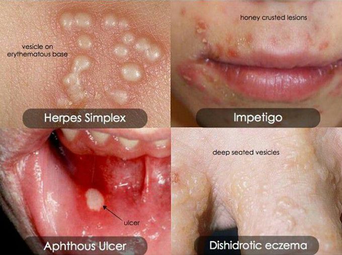 Dermatological disorders.