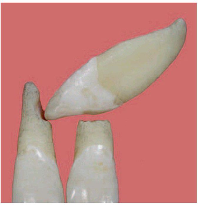Root resorption