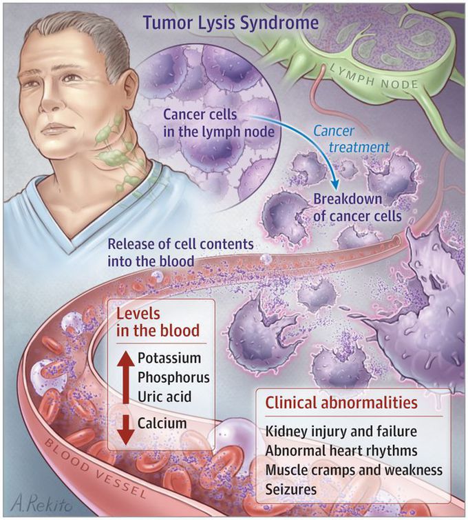 Tumour lysis Syndrome