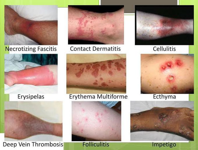 Skin lesions