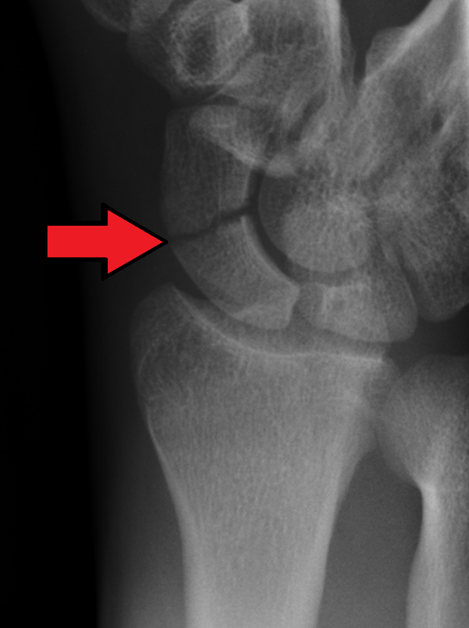 symptoms of a scaphoid fracture