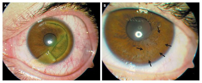 Corneal-Flap Dehiscence after Screwdriver Trauma