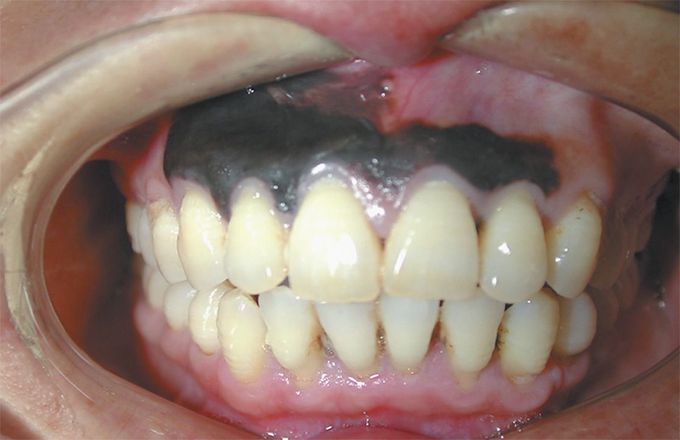 Gingival Melanoma