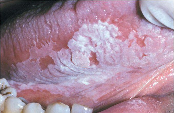 Leukoplakia