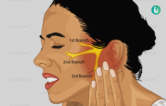 Trigeminal Neuralgia