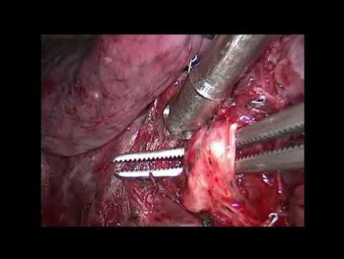 Lung-Sparing Surgery for Treatment of Pulmonary Metastases