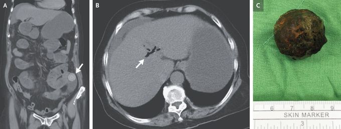 Gallstone Ileus