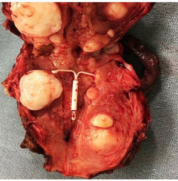 Uterus with Multiple Leiomyomas