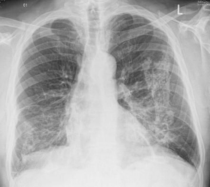 The above CXR refers to which occupational lung disease??