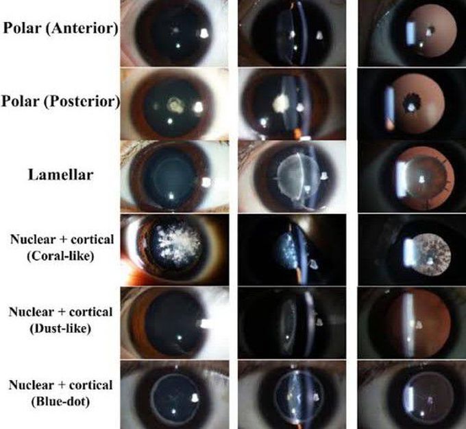 Slit Lamp images of cataracts