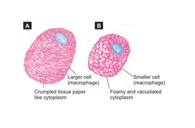 Gaucher cell and macrophage