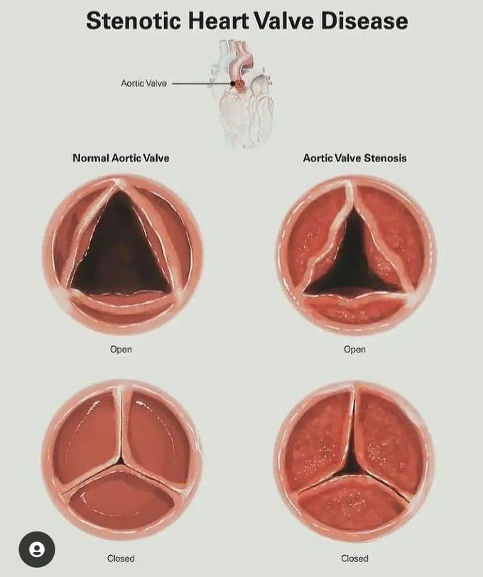 Stenotic heart valve disease